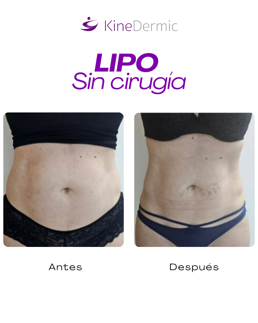 testimonio lipo sin cirugia
