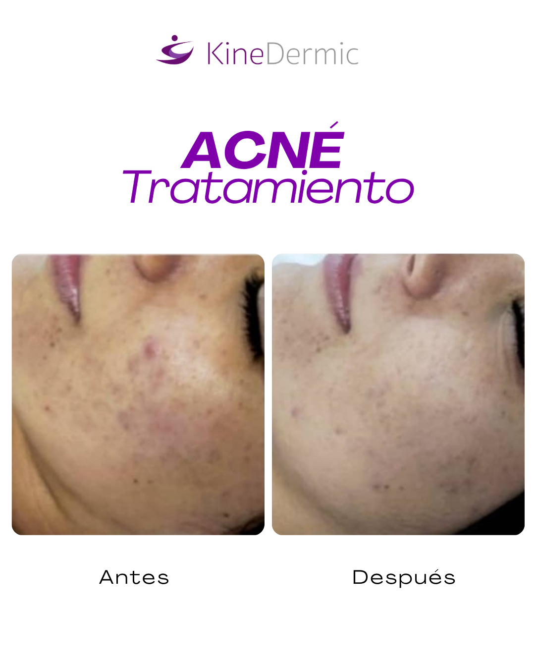testimonio tratamiento acne